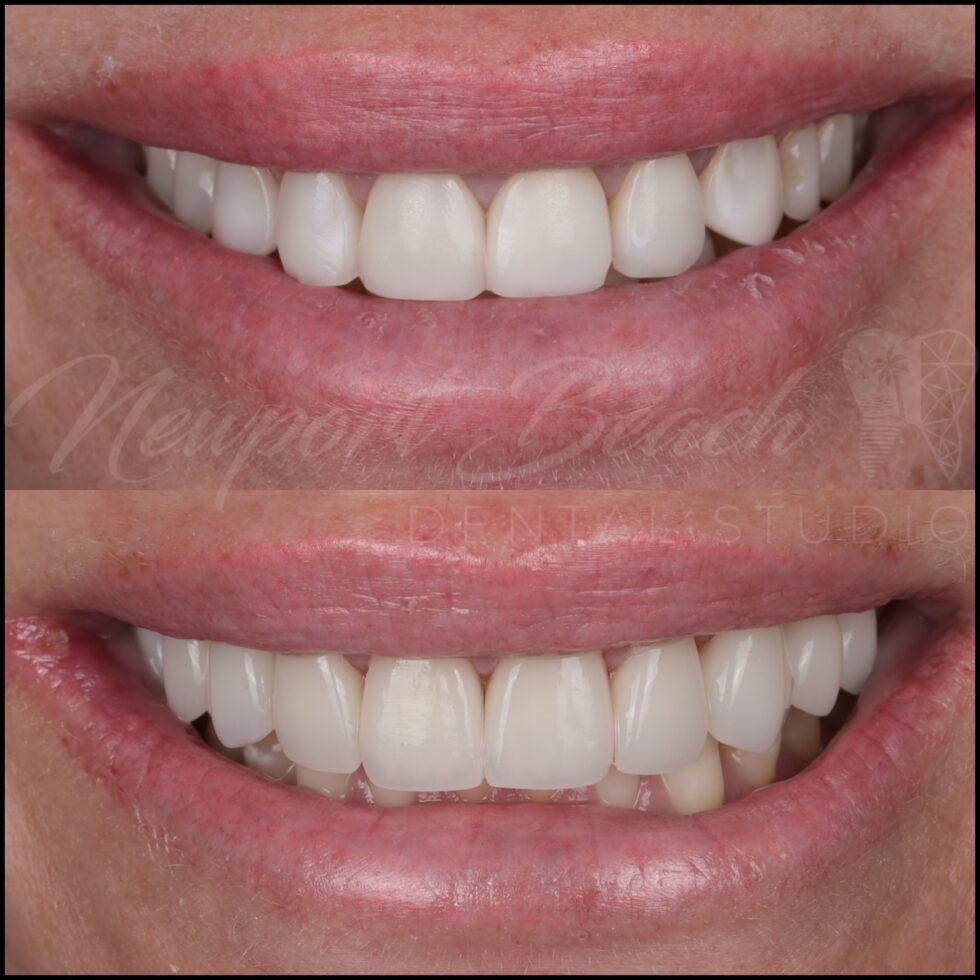 Before and after replacement of 10 aging zirconia veneers with layered E.max BL4 MT veneers improving tooth proportions, translucency and smile harmony at Newport Beach Dental Studio