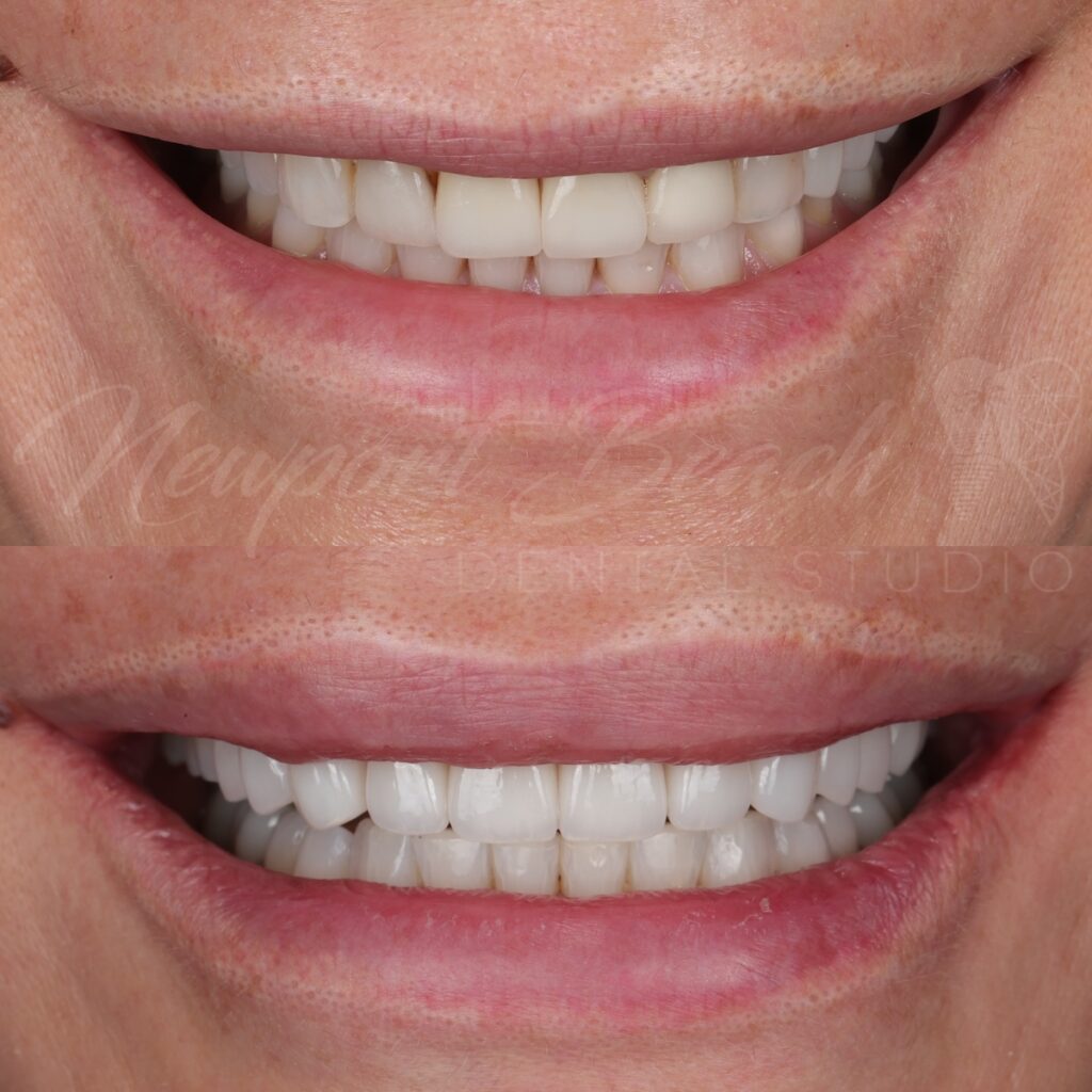 Replacing 4 Old Veneers With 10 Layered E.max Veneers