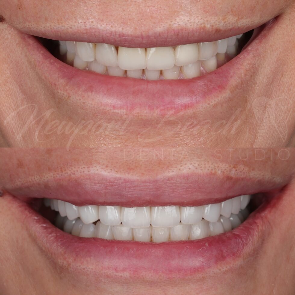 Before and after 10 layered E.max porcelain veneers replacing four aging front veneers and improving tooth color, proportions, black triangles and buccal corridors at Newport Beach Dental Studio