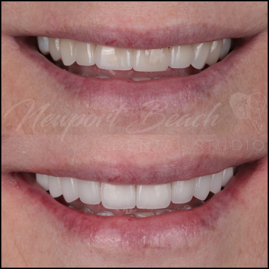 Replacing Old Veneers With Layered E.max Porcelain Veneers