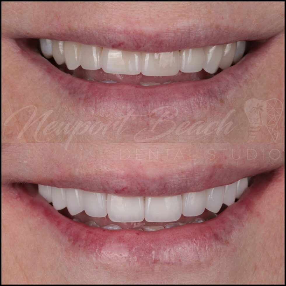 Before and after replacement of older porcelain veneers with layered E.max veneers improving tooth proportions, smile curve and overall smile harmony at Newport Beach Dental Studio