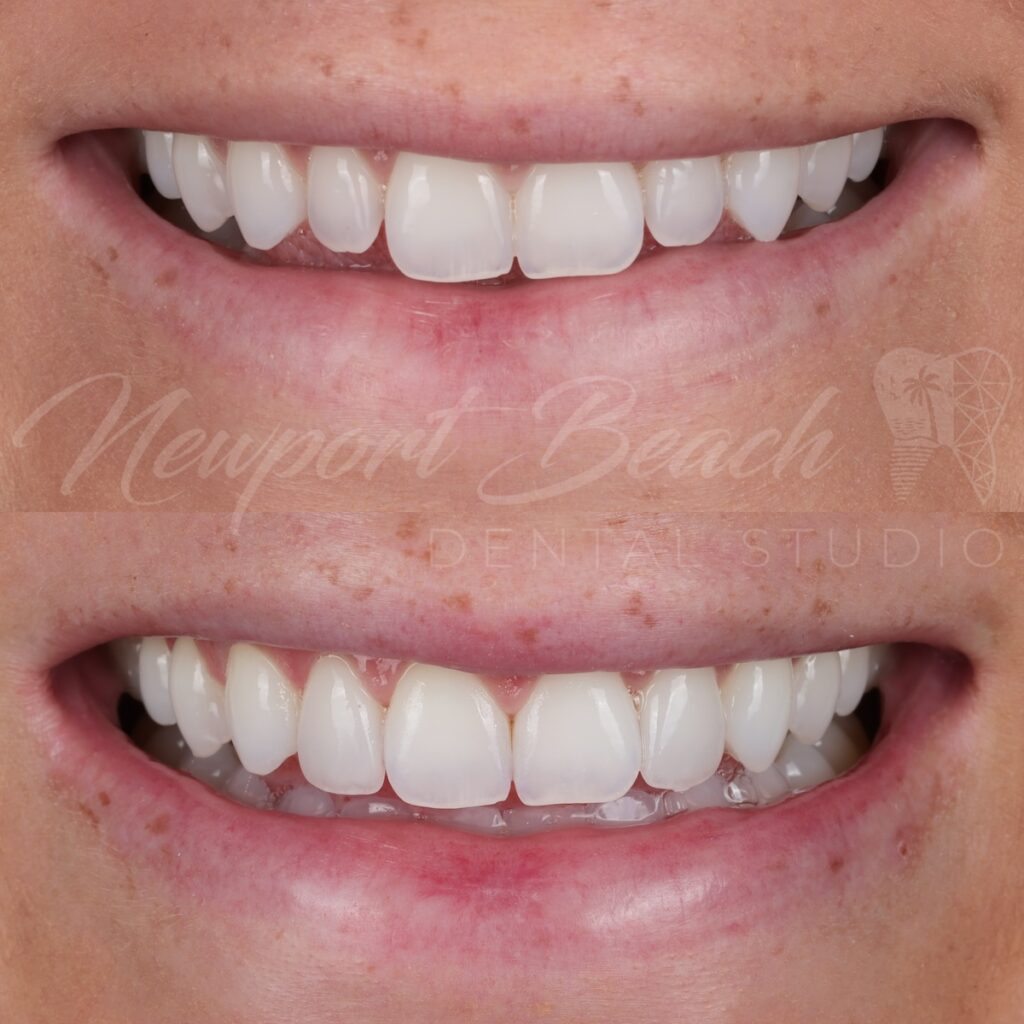 2 No-Prep Feldspathic Veneers for Small Lateral Incisors