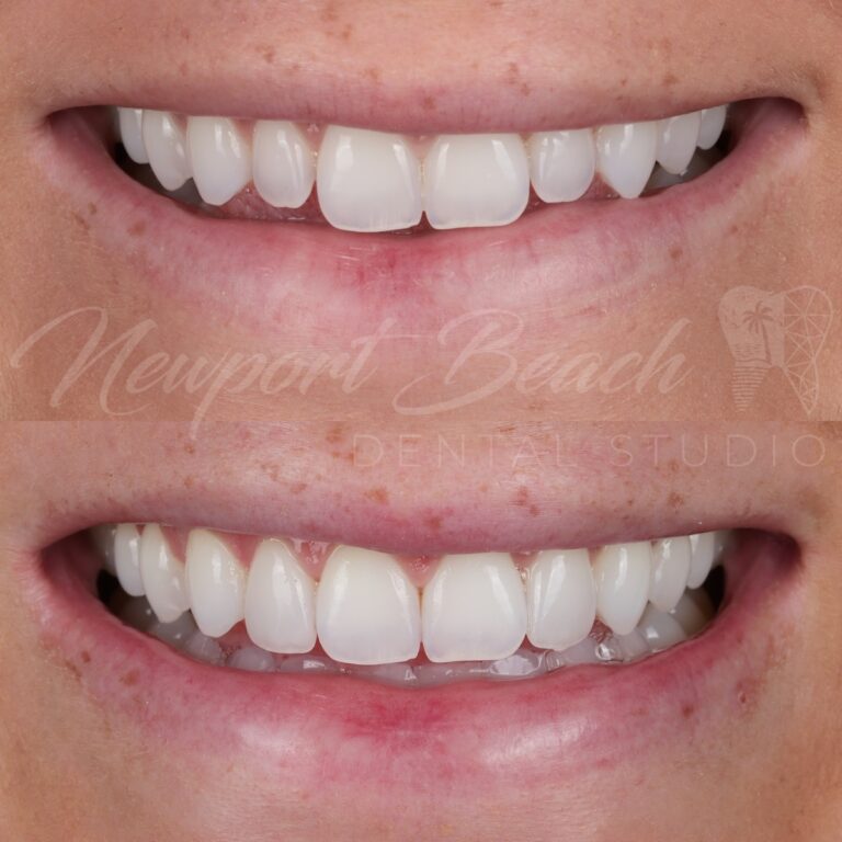 Before and after two no-prep feldspathic porcelain veneers on the upper lateral incisors improving tooth proportions and smile balance at Newport Beach Dental Studio