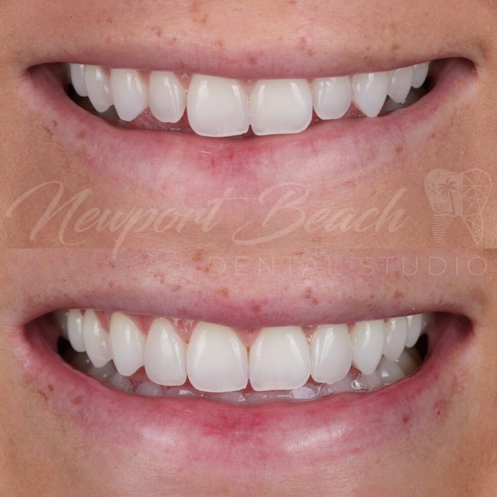 Before and after two no-prep feldspathic porcelain veneers on the upper lateral incisors improving tooth proportions and smile balance at Newport Beach Dental Studio