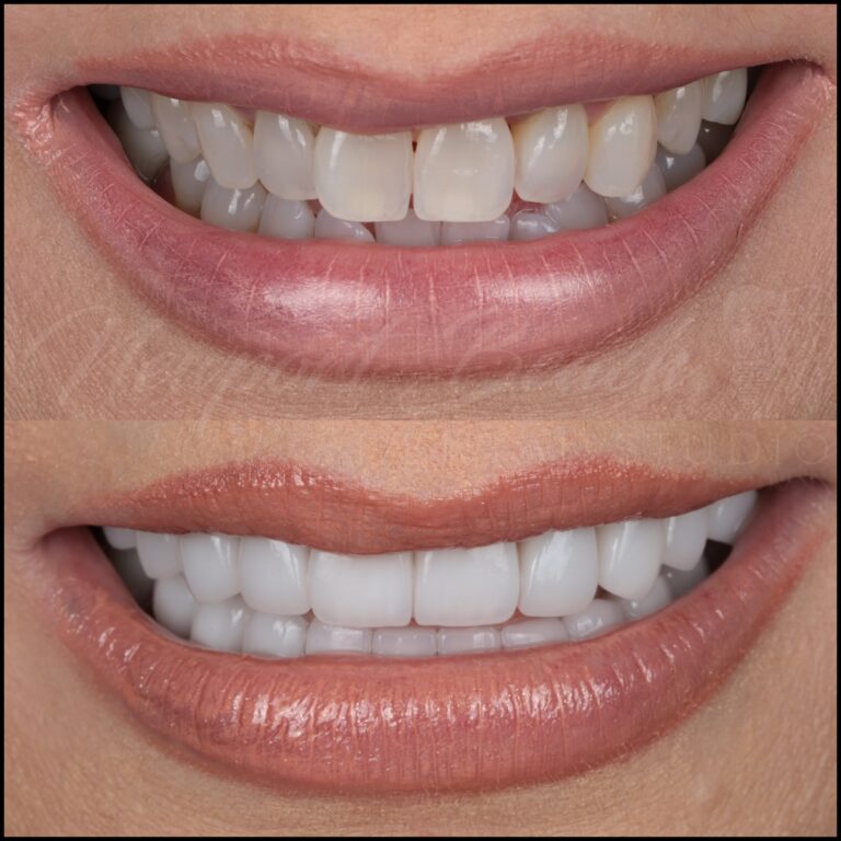 Before and after 20 layered E.max porcelain veneers improving black triangles, uneven tooth shapes, angulation and discoloration at Newport Beach Dental Studio