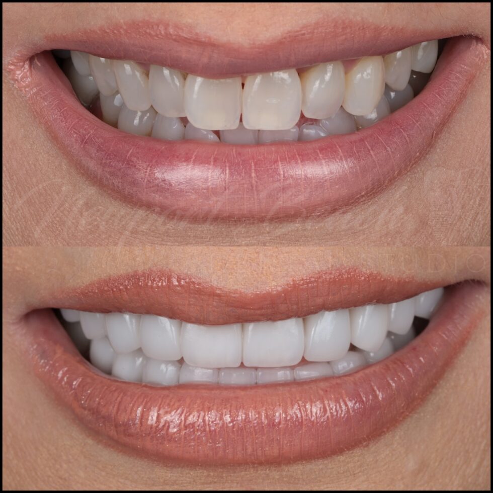 Before and after 20 layered E.max porcelain veneers improving black triangles, uneven tooth shapes, angulation and discoloration at Newport Beach Dental Studio