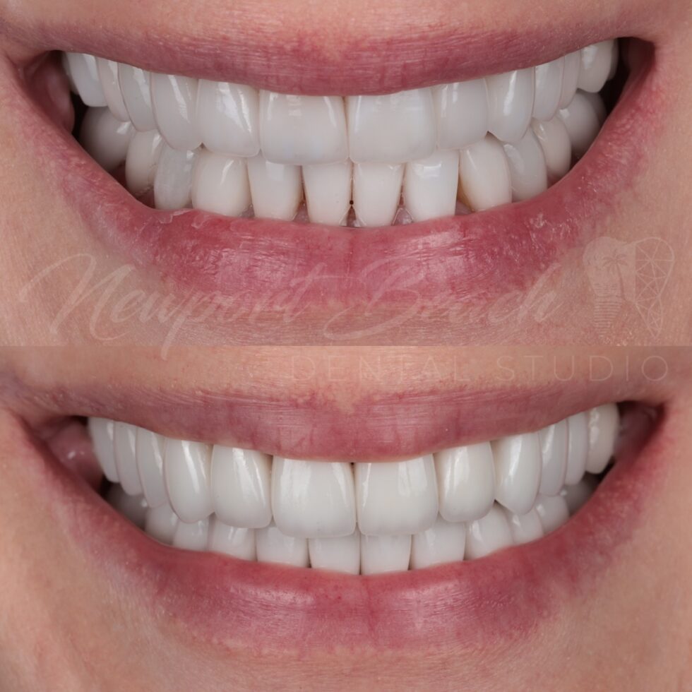 Before and after replacement of 20 older porcelain veneers with layered E.max BL2 LT veneers improving tooth length, proportions, color and smile harmony at Newport Beach Dental Studio