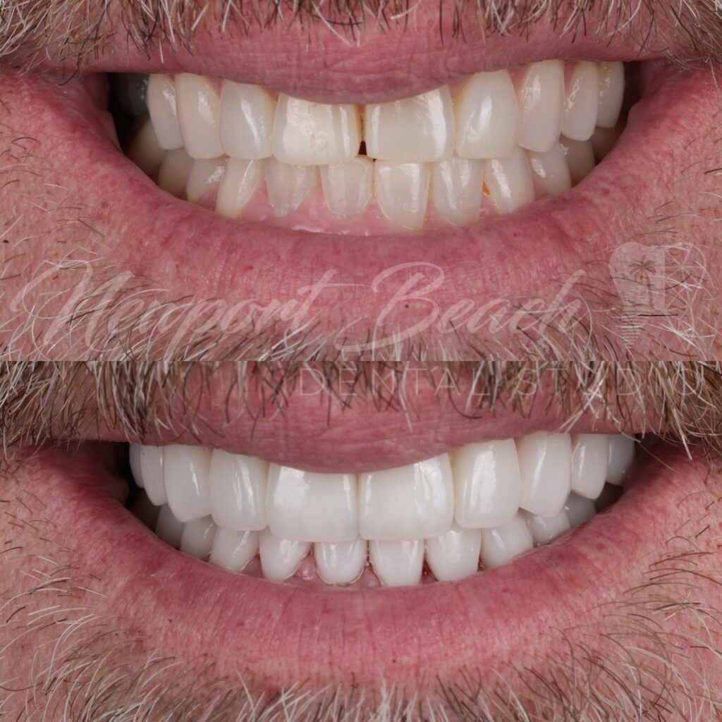 20 Layered E.max Crowns for Staining, Wear & Smile Asymmetry