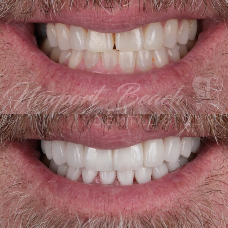 Before and after 20 layered E.max ceramic restorations improving tooth staining, wear, smile asymmetry and tooth display at Newport Beach Dental Studio