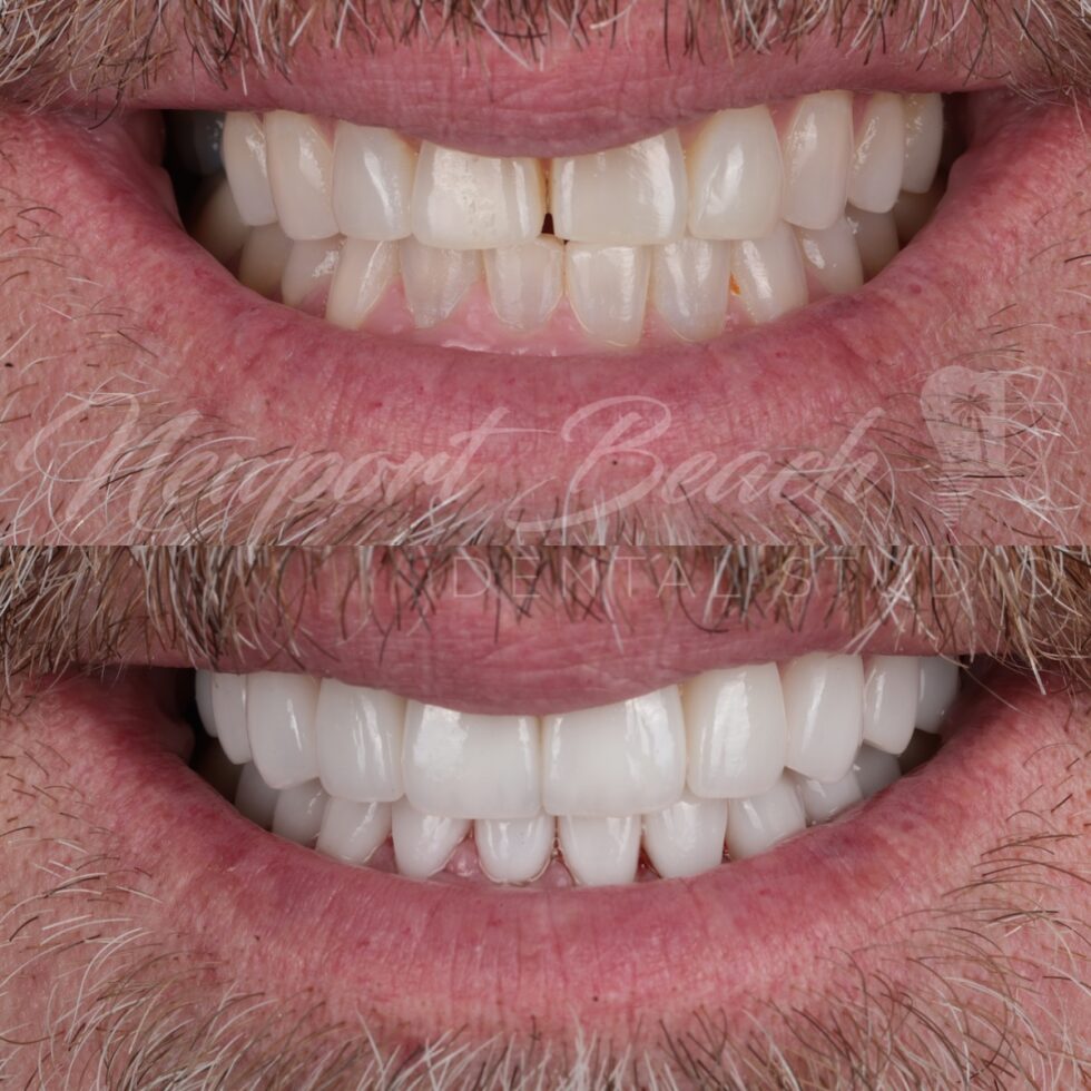 Before and after 20 layered E.max ceramic restorations improving tooth staining, wear, smile asymmetry and tooth display at Newport Beach Dental Studio