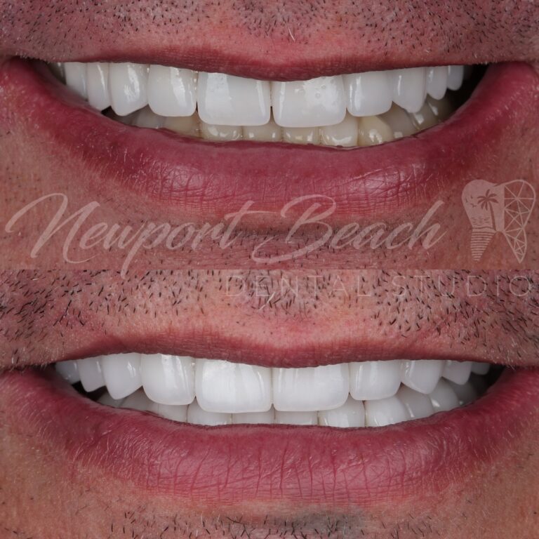 Before and after replacement of older monolithic E.max veneers with layered E.max BL2 MT veneers improving smile curve, tooth proportions, embrasures and translucency at Newport Beach Dental Studio