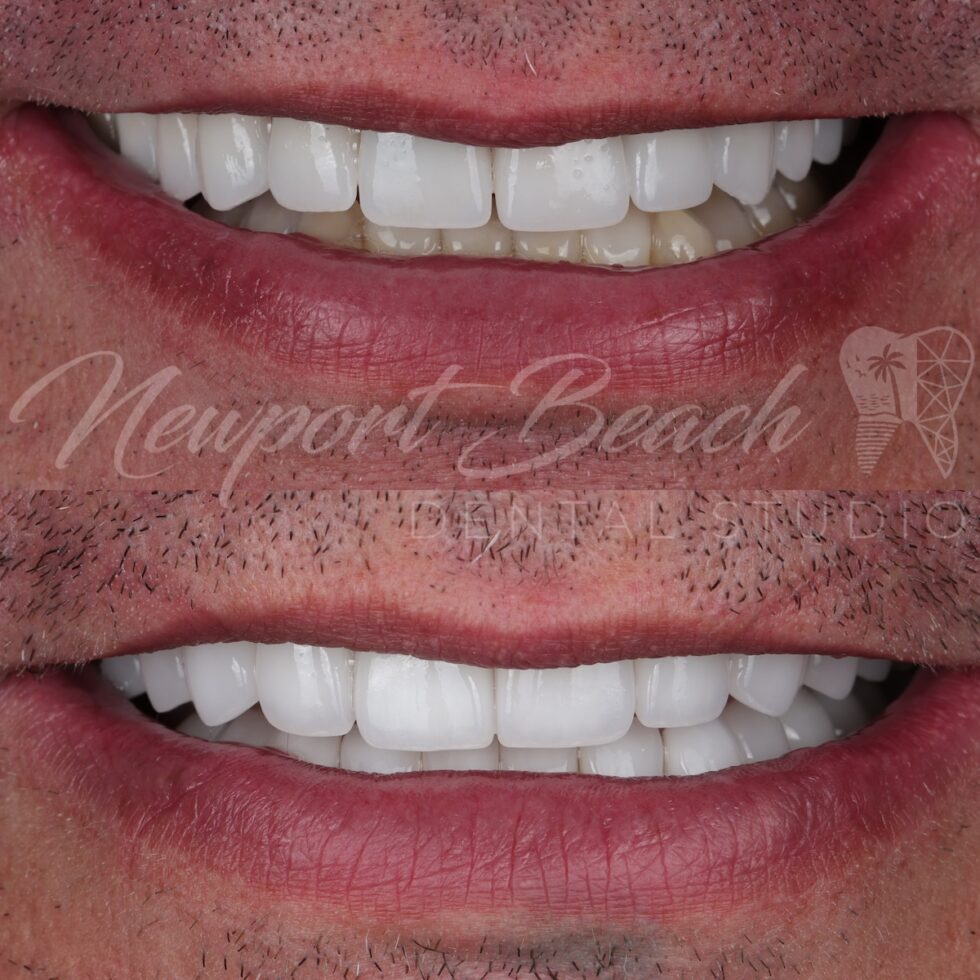 Before and after replacement of older monolithic E.max veneers with layered E.max BL2 MT veneers improving smile curve, tooth proportions, embrasures and translucency at Newport Beach Dental Studio