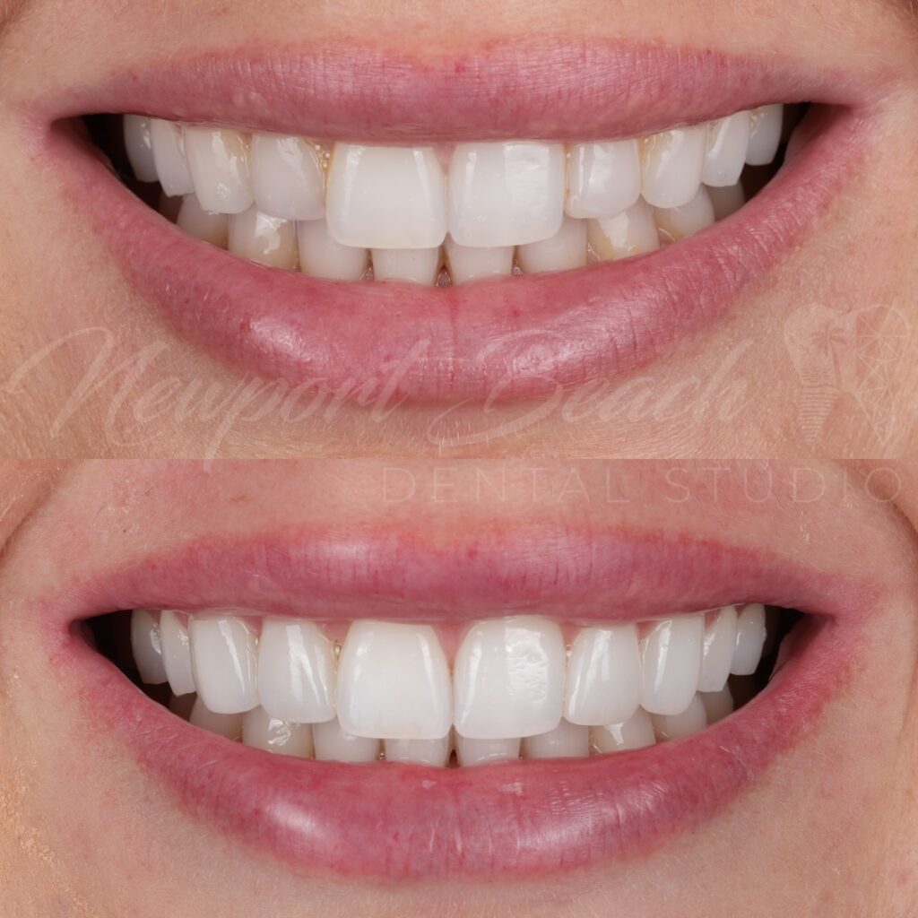 4 No-Prep Feldspathic Veneers for a Conservative Smile Makeover