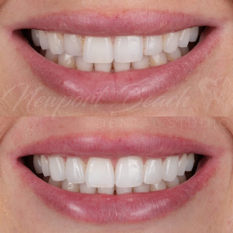 Before and after four no-prep feldspathic porcelain veneers on the upper lateral incisors and canines improving tooth proportions, alignment and smile harmony at Newport Beach Dental Studio