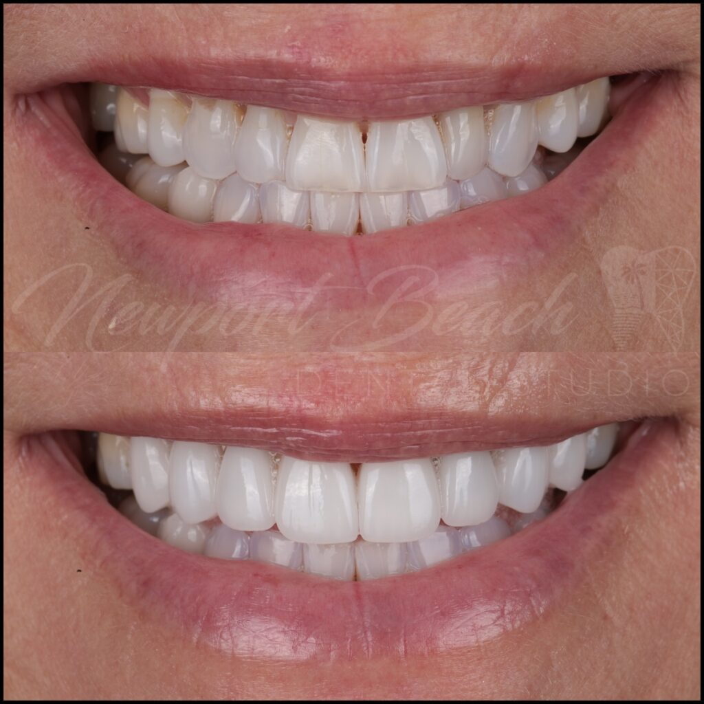 8 Layered E.max Veneers to Correct Wear, Color & Black Triangles