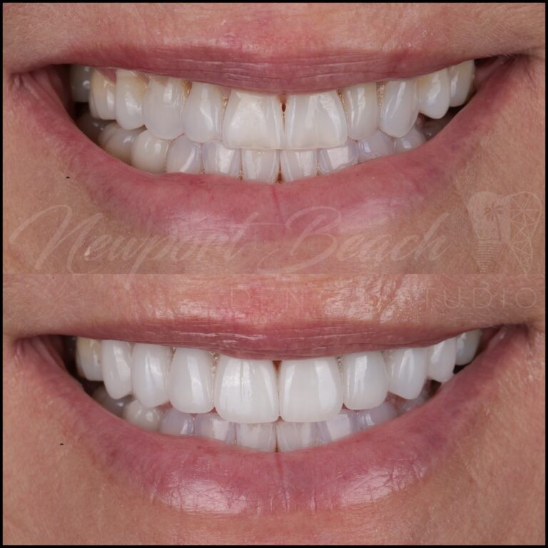 Before and after 8 layered E.max porcelain veneers correcting worn teeth, black triangles, tooth angulation and discoloration at Newport Beach Dental Studio