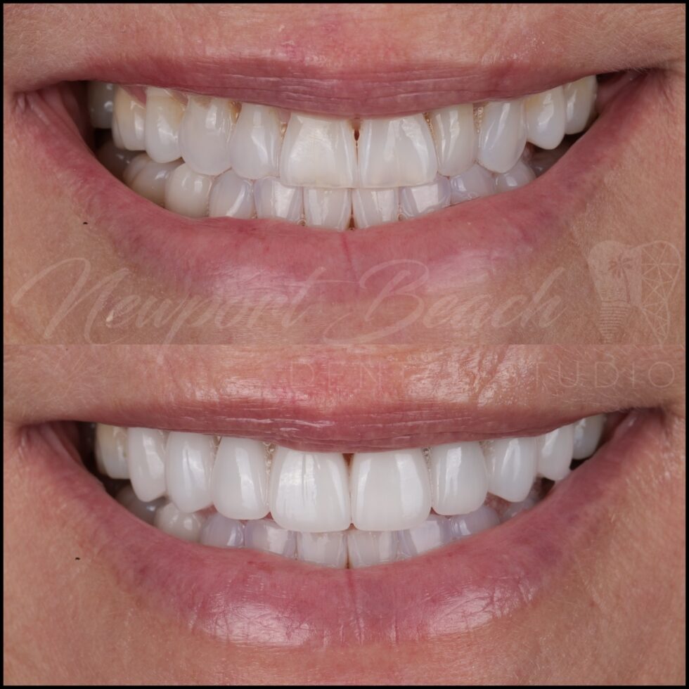 Before and after 8 layered E.max porcelain veneers correcting worn teeth, black triangles, tooth angulation and discoloration at Newport Beach Dental Studio