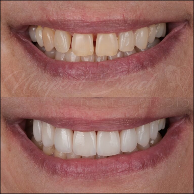 Before and after 8 layered E.max porcelain veneers improving tooth gaps, small teeth, color and smile proportions at Newport Beach Dental Studio