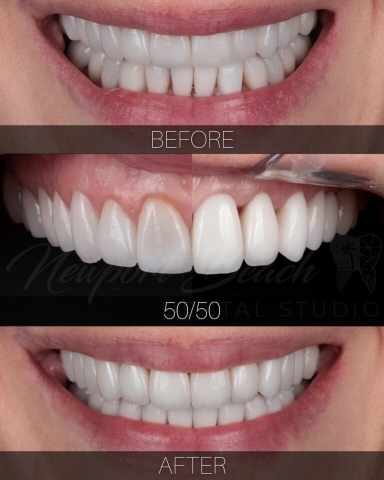 Before 50/50 and after comparison of 20 replacement layered E.max BL2 LT veneers showing improved color, tooth length, proportions and smile fullness at Newport Beach Dental Studio