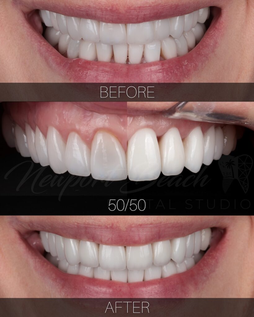 Cosmetic dentistry before and after smile transformation in Newport Beach