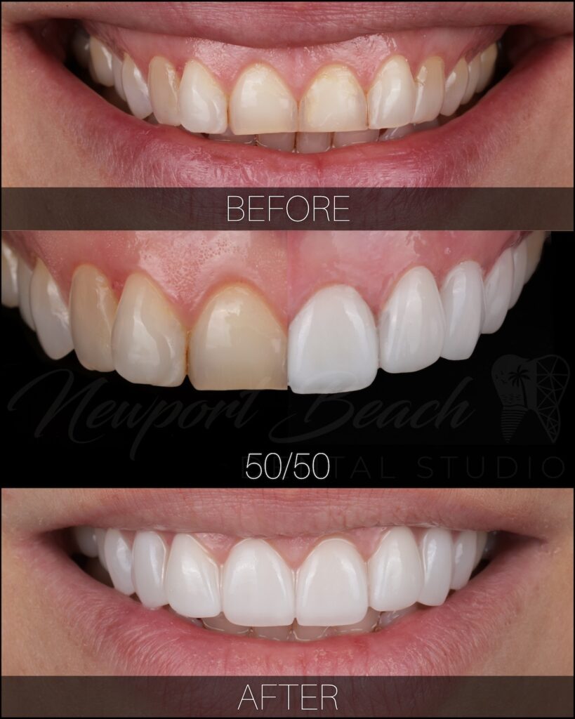 Cosmetic dentistry before and after correcting worn and discolored front teeth