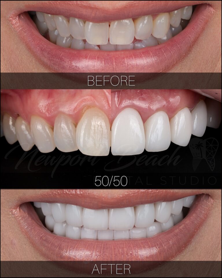 Before and after 20 layered E.max porcelain veneers improving black triangles, uneven tooth shapes, angulation and discoloration at Newport Beach Dental Studio