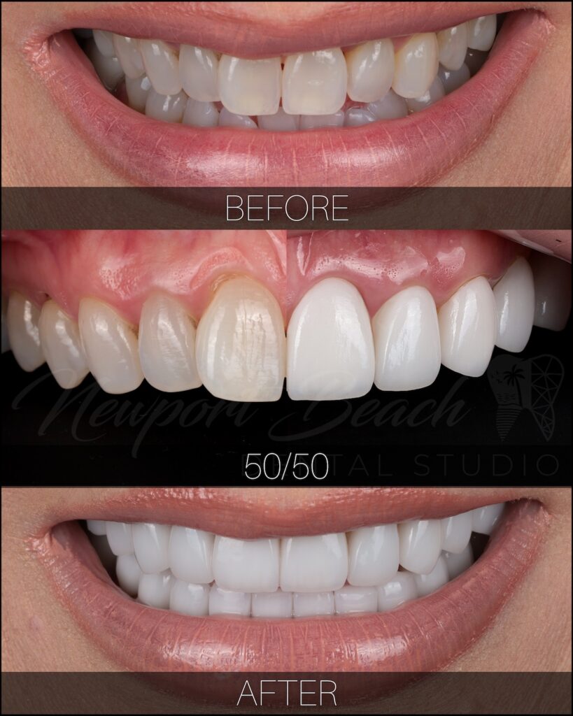 Natural porcelain veneers before and after smile transformation