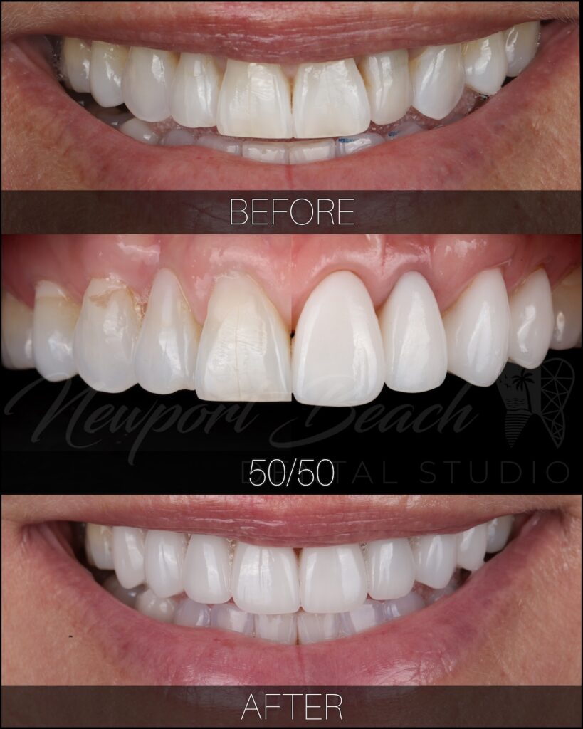 Before and after veneer treatment improving tooth shape and smile harmony