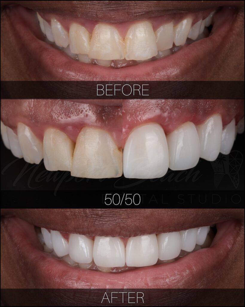 Cosmetic dentistry before and after with brighter more symmetrical front teeth
