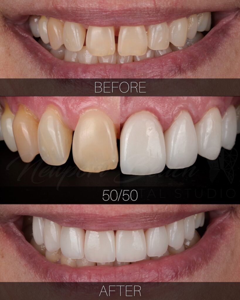 Newport Beach Dental Studio | Dr. Tai Ha, DDS Cosmetic dentistry before and after with brighter more symmetrical front teeth