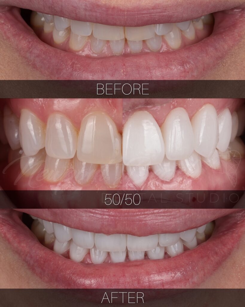Porcelain veneers before and after with improved tooth shape and symmetry