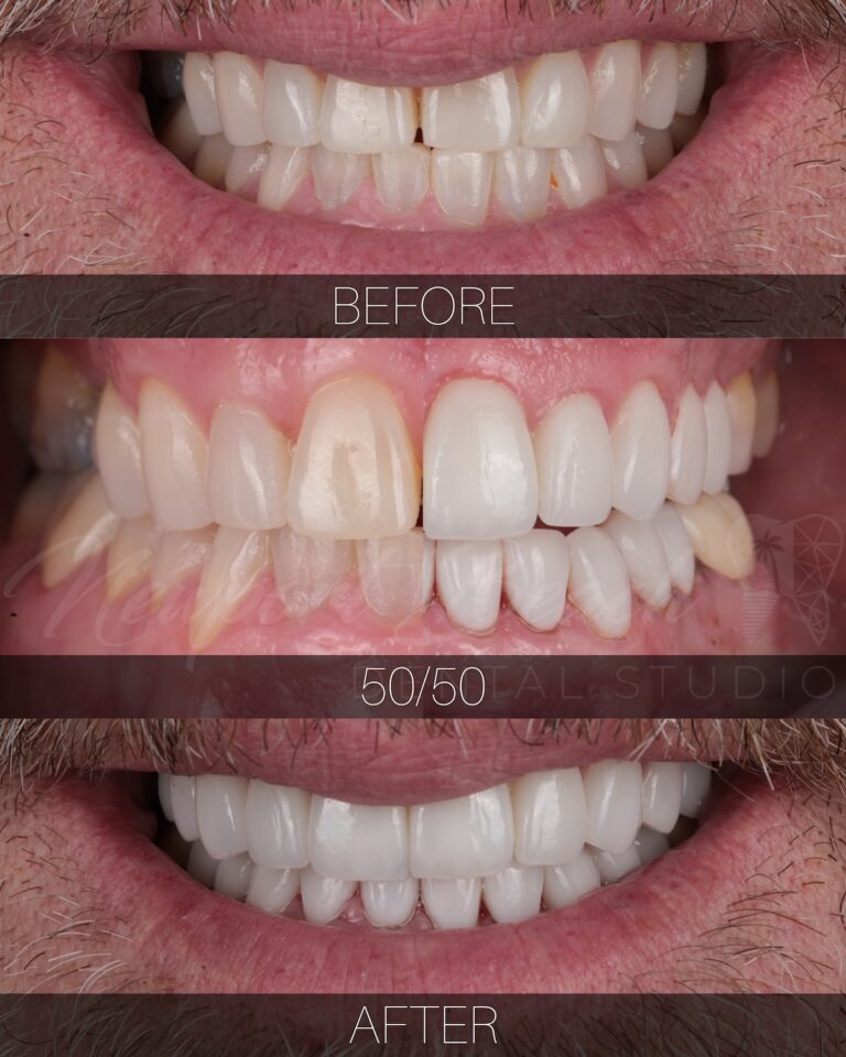 Before 50/50 and after comparison of 20 layered E.max restorations improving tooth staining, wear, tooth length and smile asymmetry at Newport Beach Dental Studio