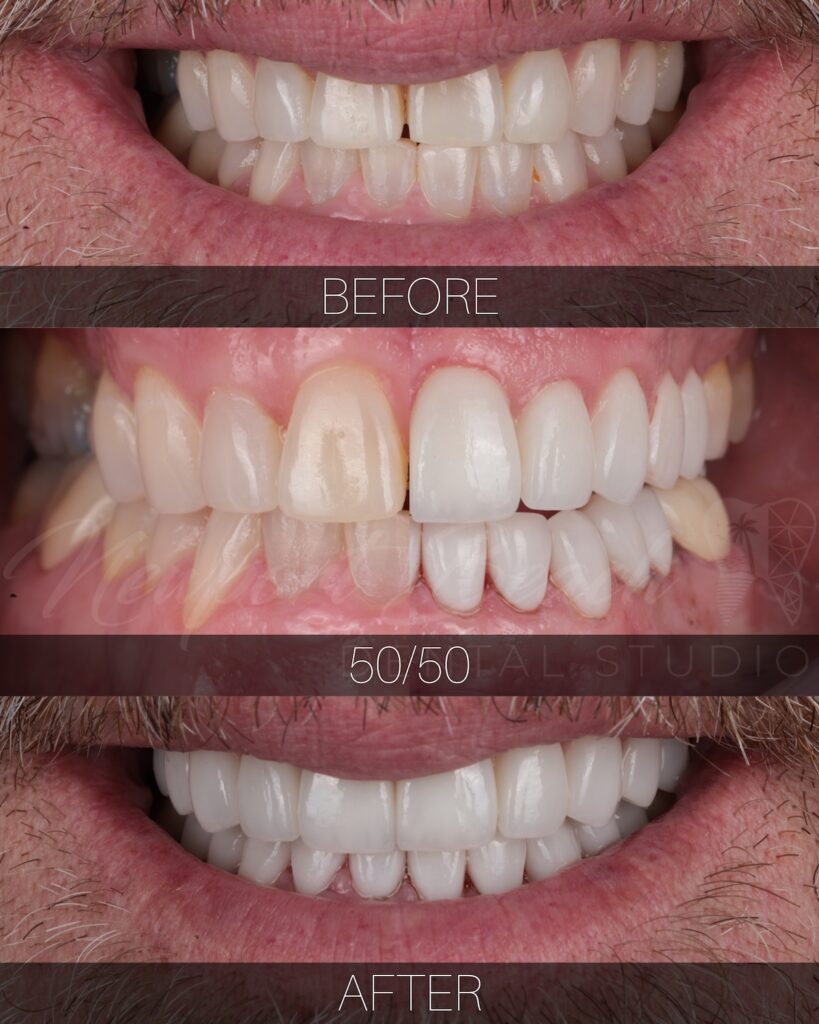 Natural looking cosmetic dentistry before and after smile makeover