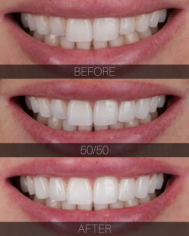 Before and after four no-prep feldspathic porcelain veneers on the upper lateral incisors and canines improving tooth proportions, alignment and smile harmony at Newport Beach Dental Studio