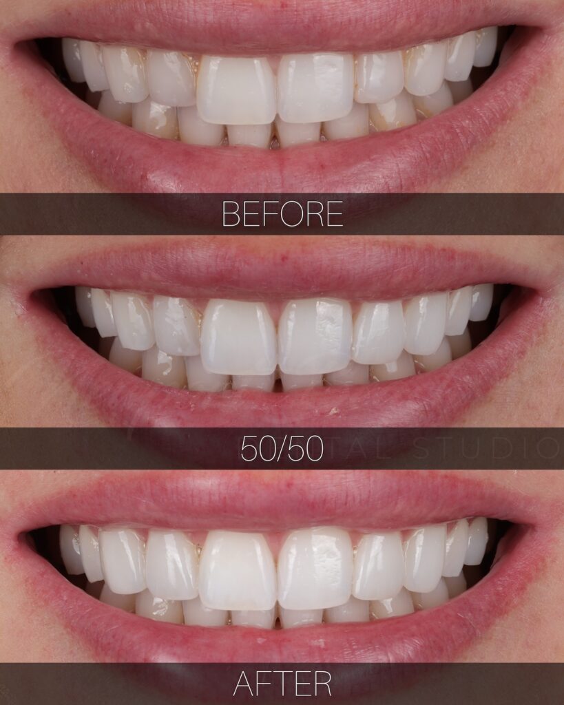 Front teeth cosmetic dentistry before and after with improved proportions