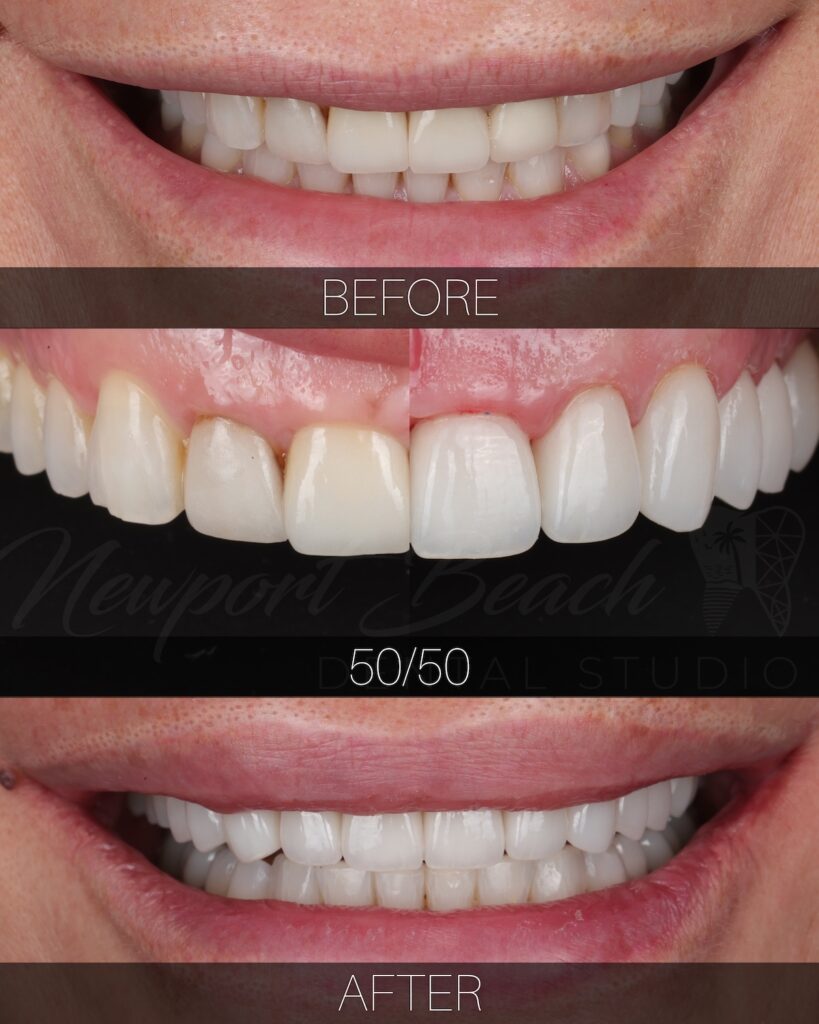 Porcelain veneer smile makeover before and after in Newport Beach