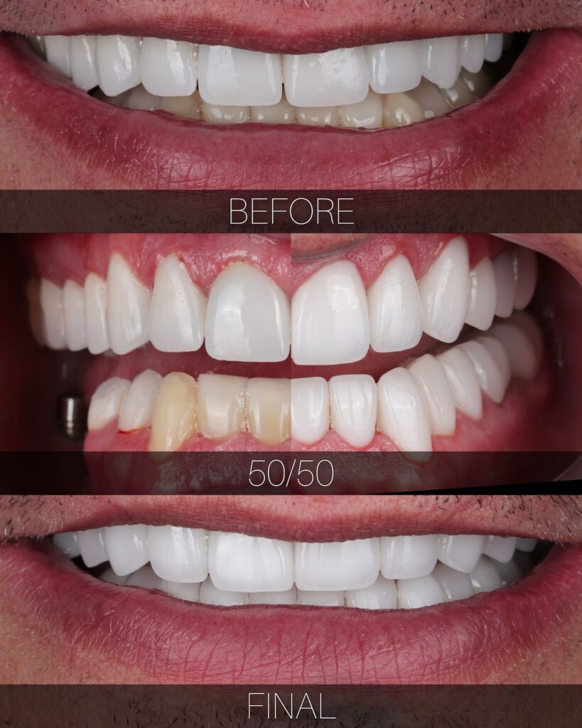 Cosmetic dental restoration before and after with improved smile balance