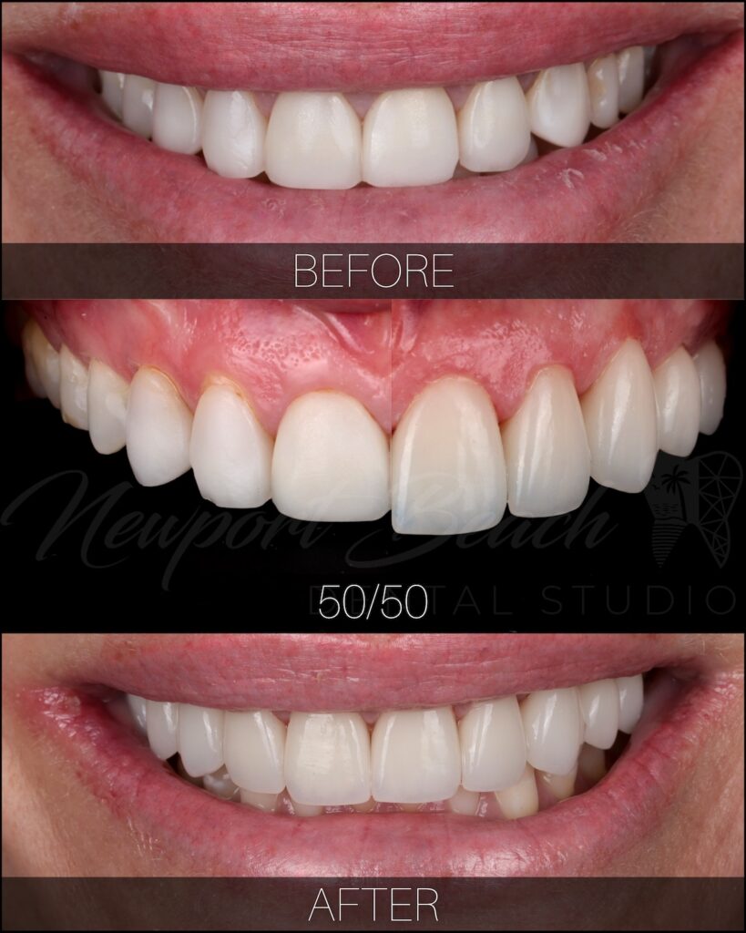 Before and after cosmetic dentistry showing improved tooth color and shape