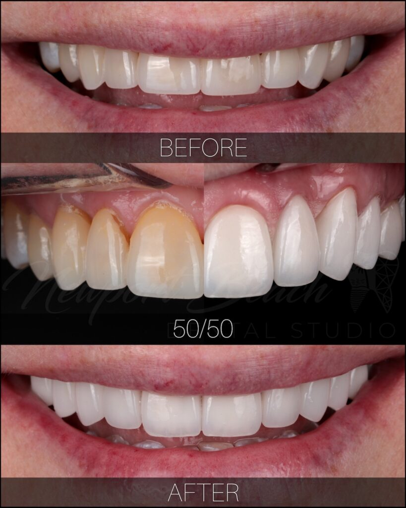 Porcelain veneers before and after correcting uneven front teeth