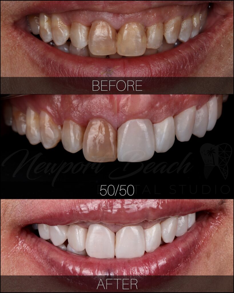 Smile makeover before and after with improved symmetry and tooth proportions