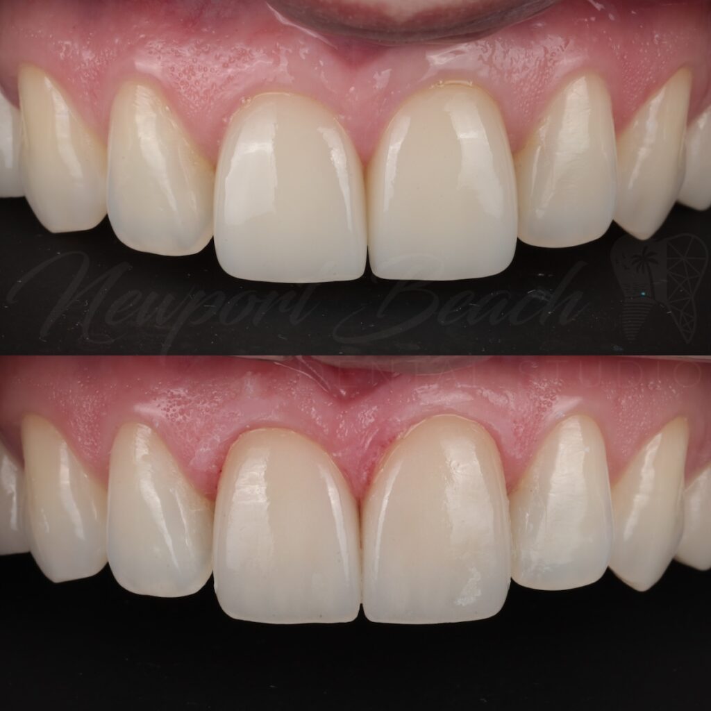 Two-Veneer Revision With Natural Shade Matching