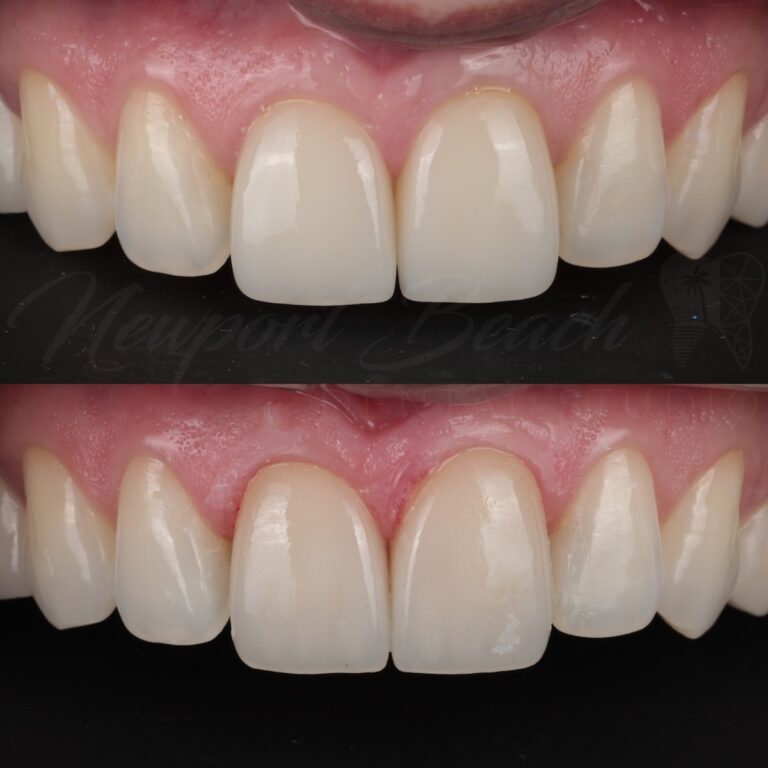Before and after replacement of porcelain veneers on teeth 8 and 9 with improved contour, shade matching and translucency at Newport Beach Dental Studio