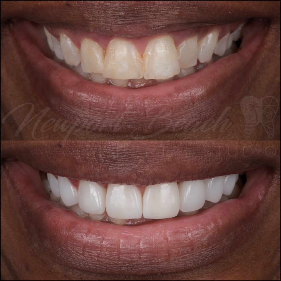 Before and after 8 layered E.max porcelain restorations correcting old bonding, midline, tooth proportions, color and symmetry at Newport Beach Dental Studio