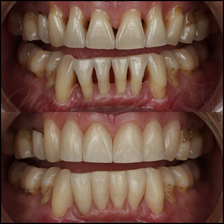 Retracted before and after dental photography showing upper and lower black triangle closure using composite and the Bioclear Matrix System