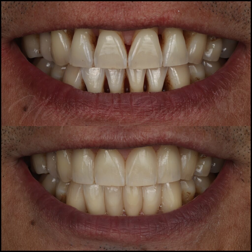 Closing Black Triangles With the Bioclear Matrix System