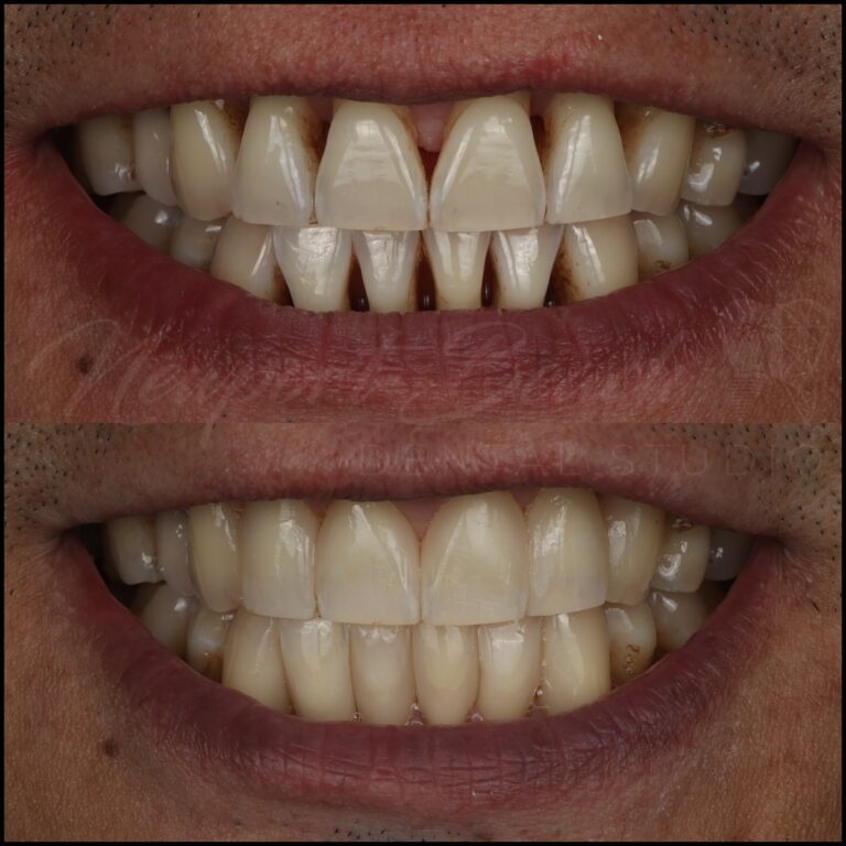 Before and after smile showing black triangle closure using the Bioclear Matrix System and composite restorations