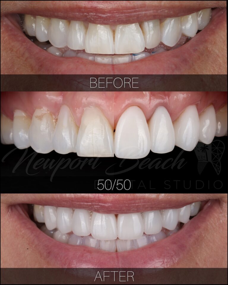 Before and after 8 layered E.max porcelain veneers correcting worn teeth, black triangles, tooth angulation and discoloration at Newport Beach Dental Studio
