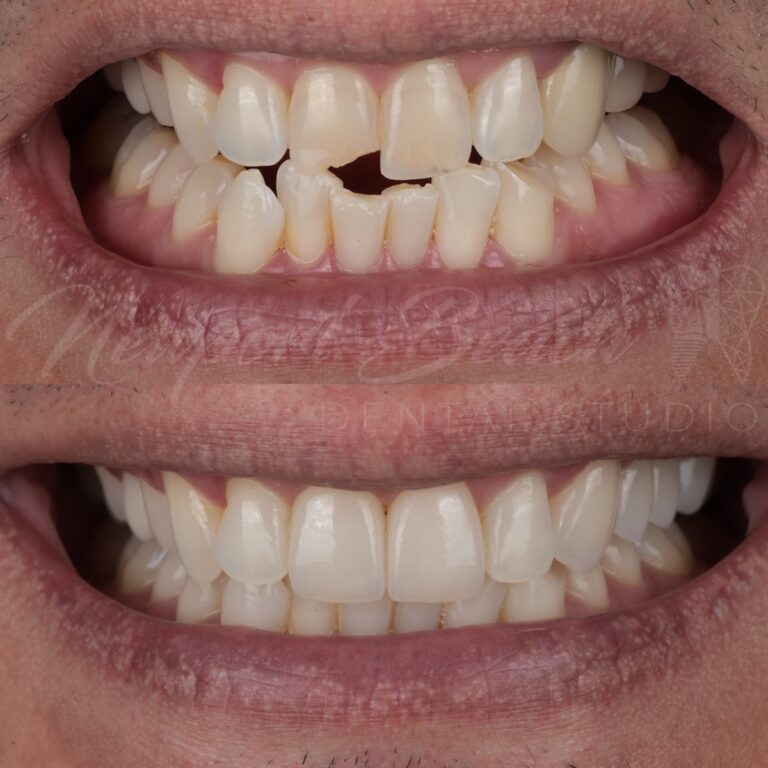 Before and after two layered E.max veneers and replacement of an upper-left PFM bridge with zirconia after KöR Whitening at Newport Beach Dental Studio