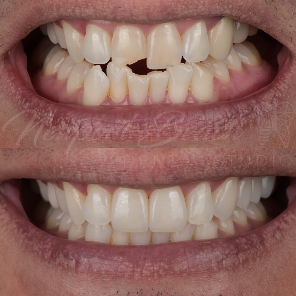 Before and after two layered E.max veneers and replacement of an upper-left PFM bridge with zirconia after KöR Whitening at Newport Beach Dental Studio
