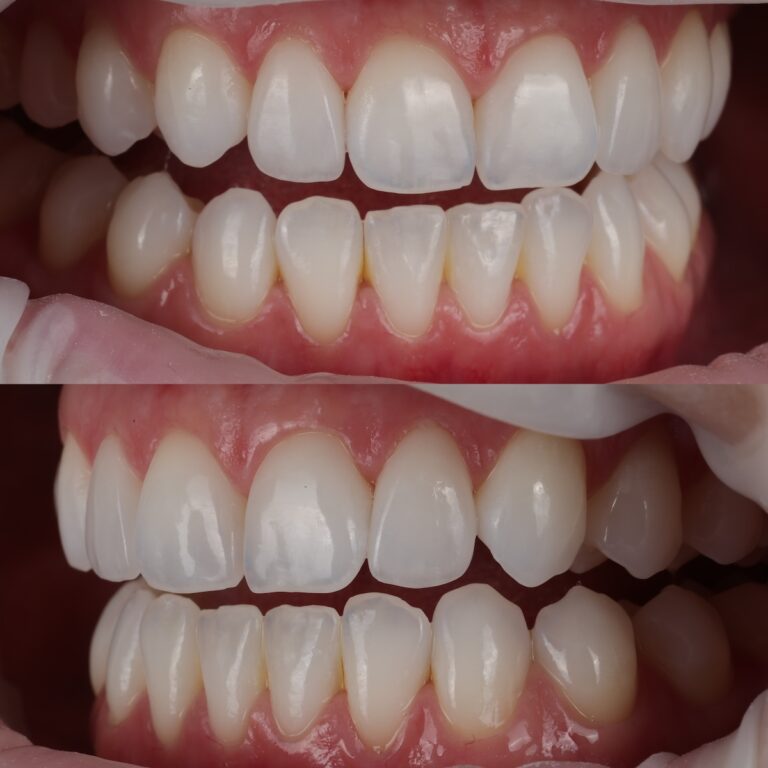 Oblique views of two no-prep feldspathic veneers on teeth 7 and 10 showing color match, translucency and integration with surrounding natural teeth